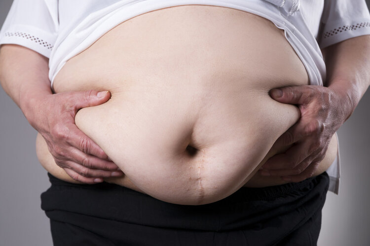 How to Lose Weight for Severely Obese People